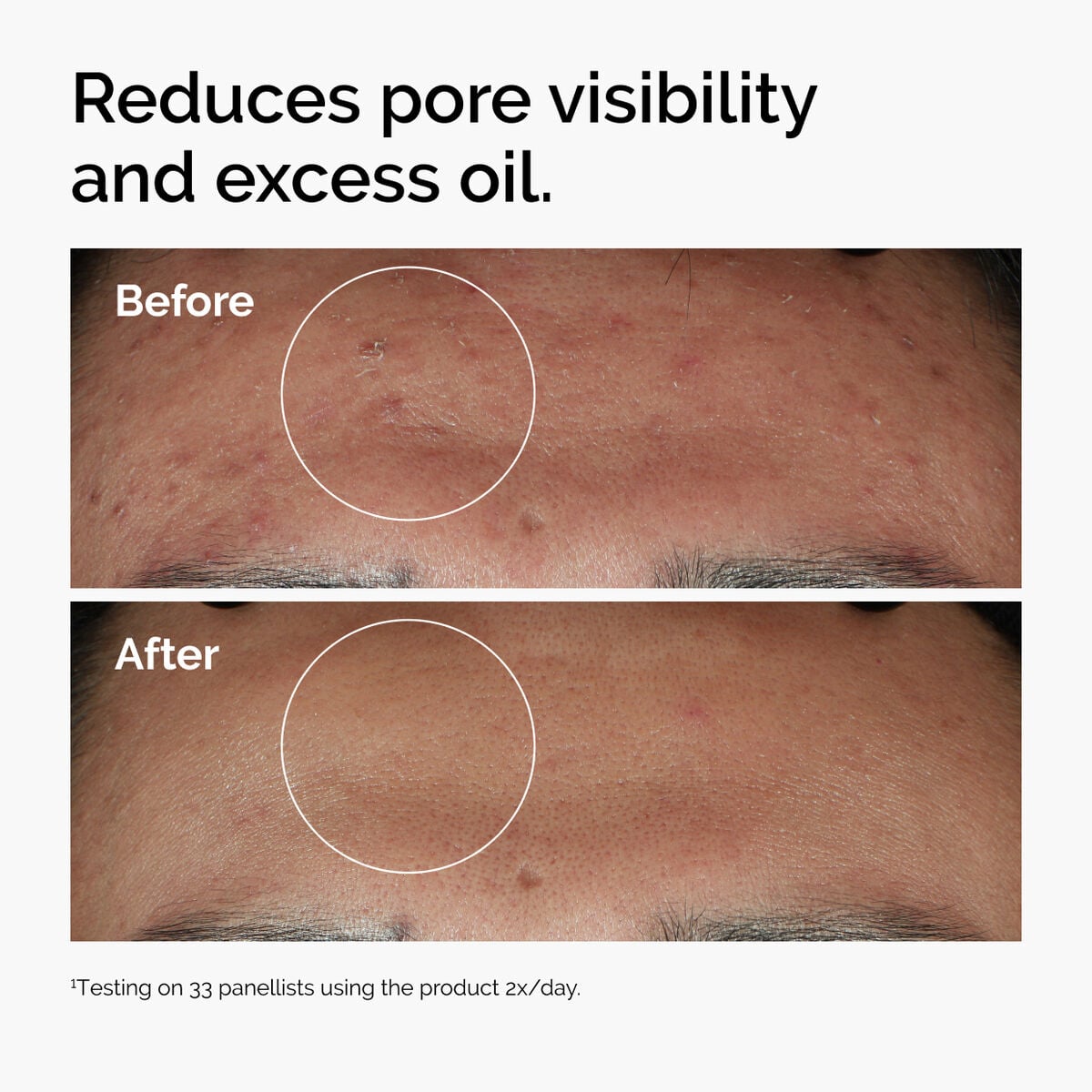 niacinamide-10-zinc-1-i5 ord-niacinamide-zinc-blemish-serum-before-after-pores.jpg