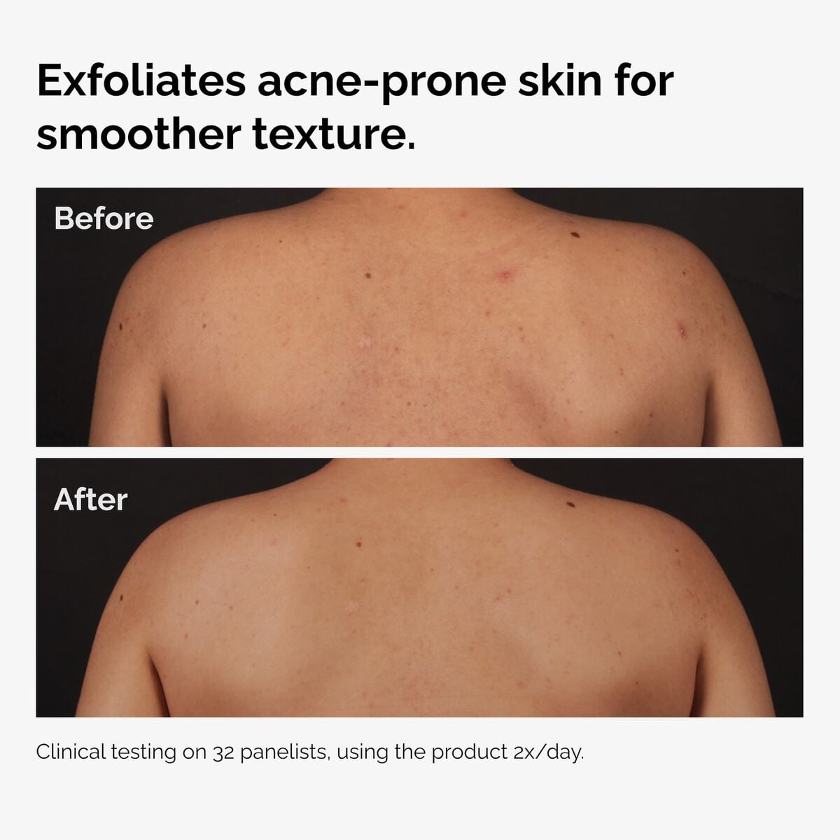 salicylic-acid-0-5-body-serum-j3 ord-salicylic-acid-body-serum-before-after-graphic-NA.jpg