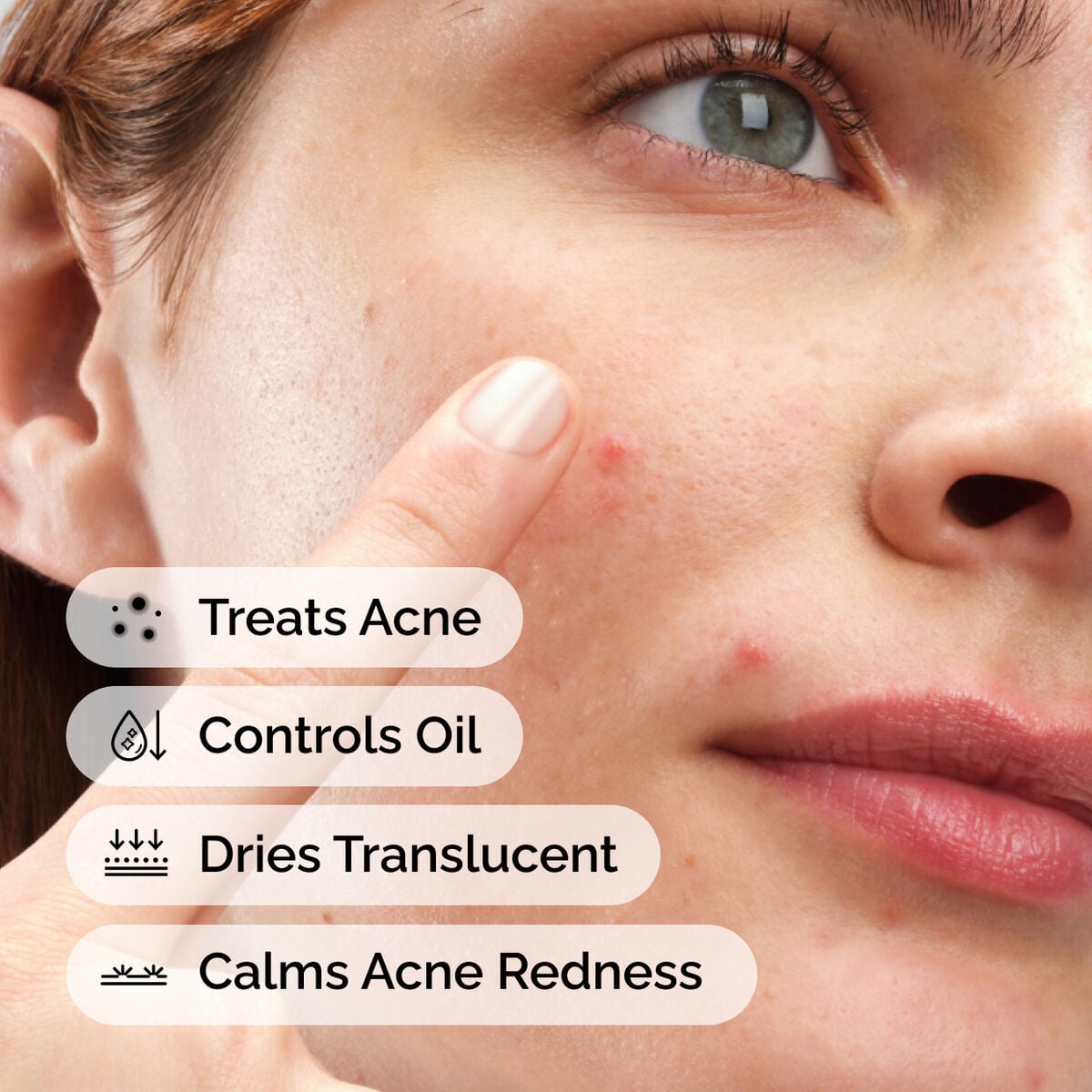 sulfur-10-powder-to-cream-concentrate-n4 ord-sulfur-10pct-powder-to-cream-concentrate-model-application-with-benefits-acne.jpg
