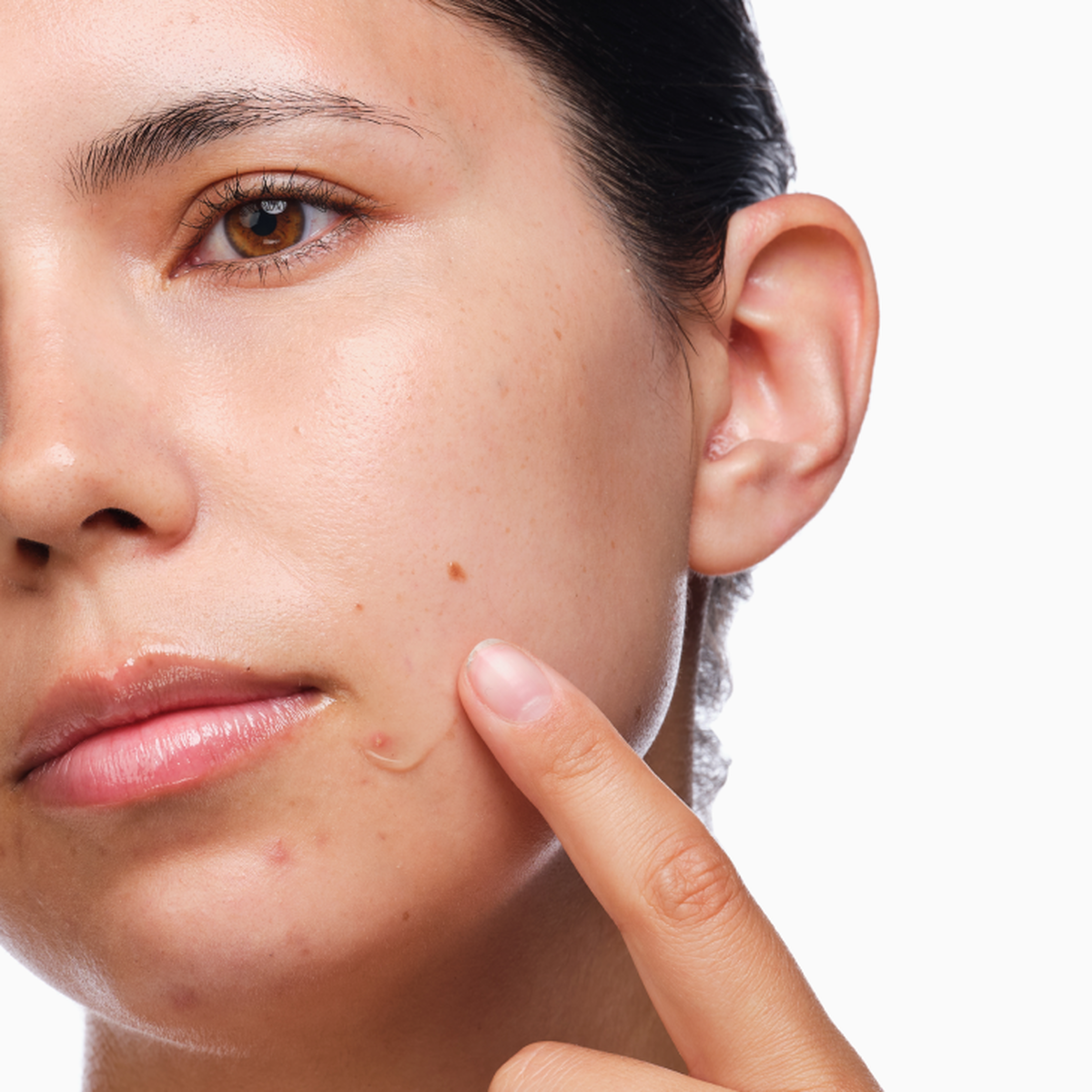 the-acne-set-d9 rdn-the-acne-set-application.png